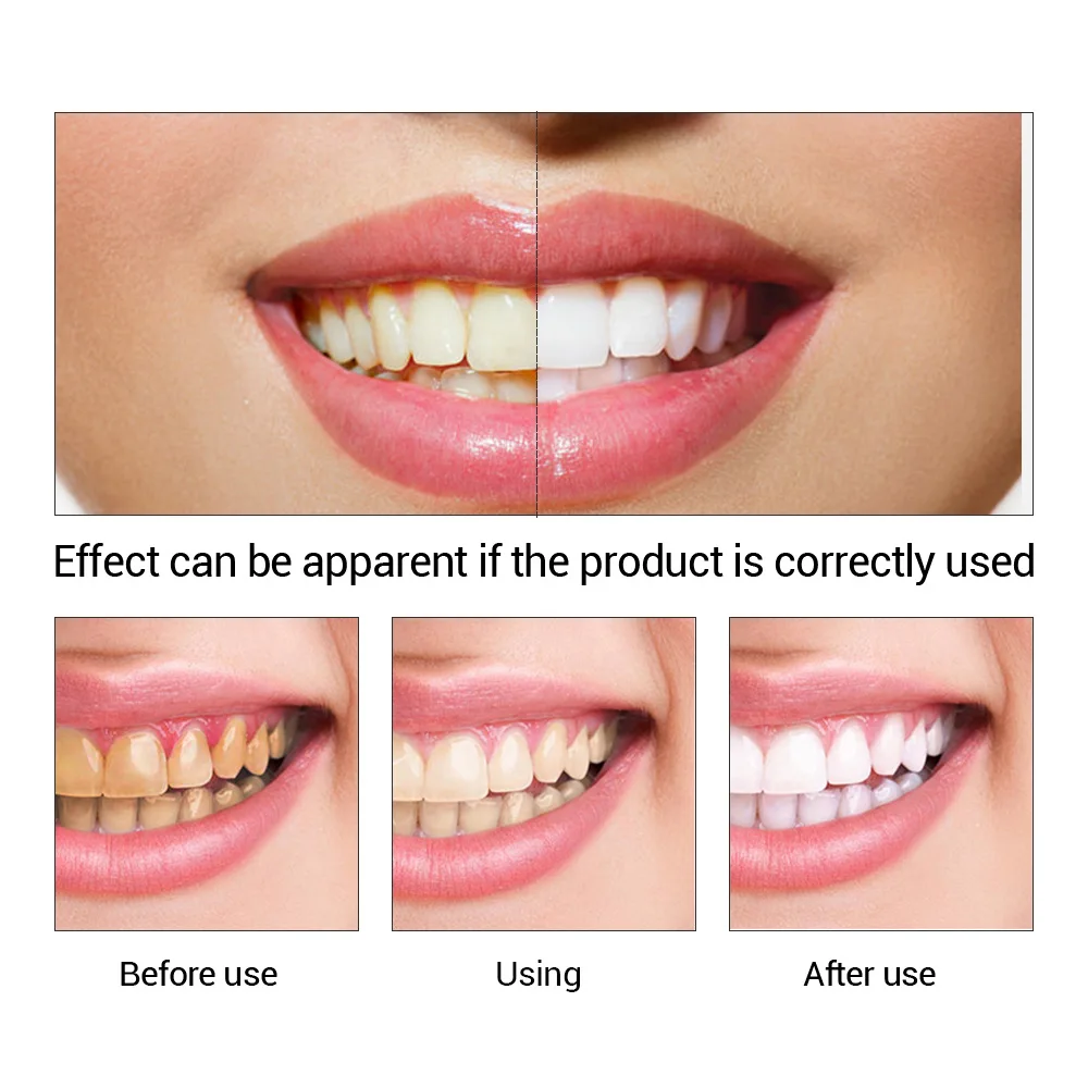 FTEENPLY Zahnaufhellung Essenz – Teeth Whitening Co Bewertung und Preis