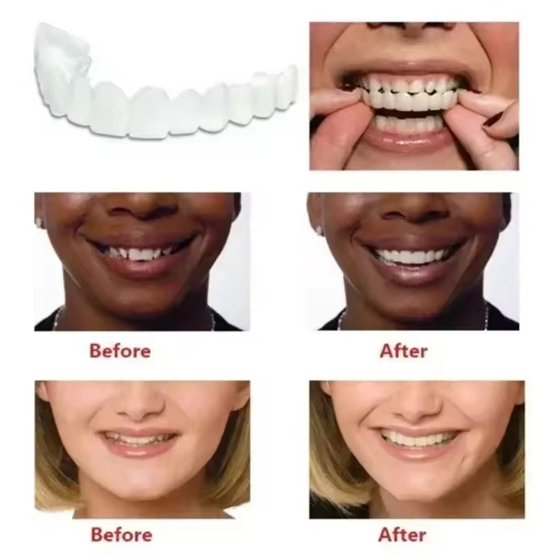 Zahn-Veneers Zahnaufhellung Za – Teeth Whitening Session Bewertung und Preis