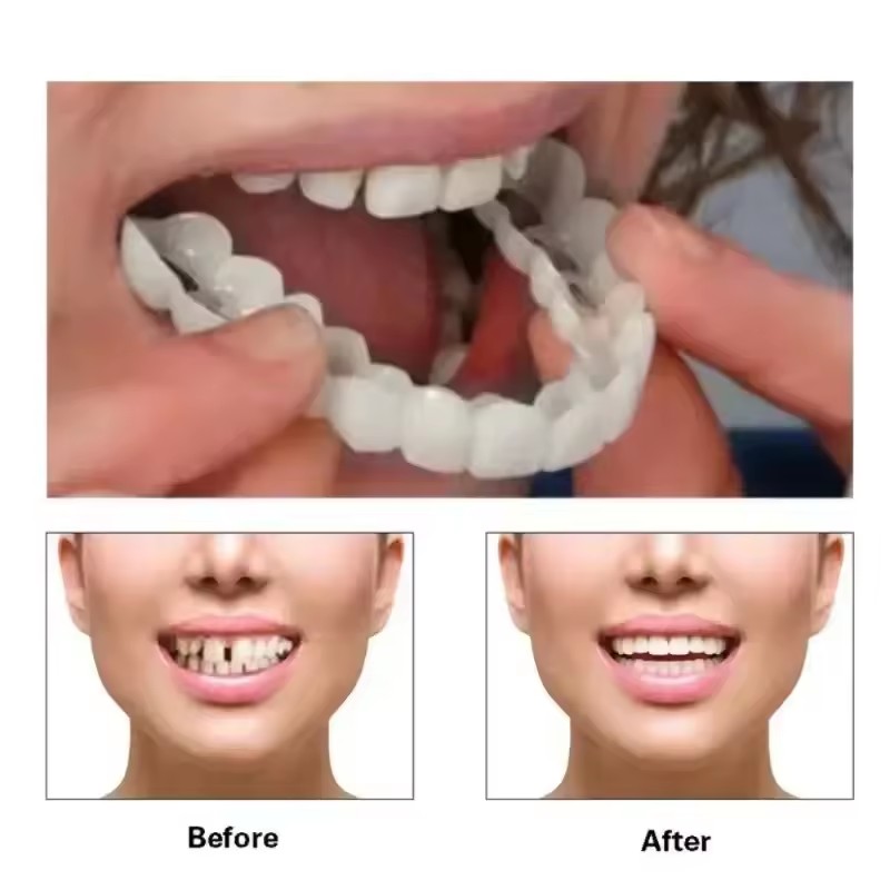 Zahn-Veneers Zahnaufhellung Za – Teeth Whitening Session Bewertung und Preis